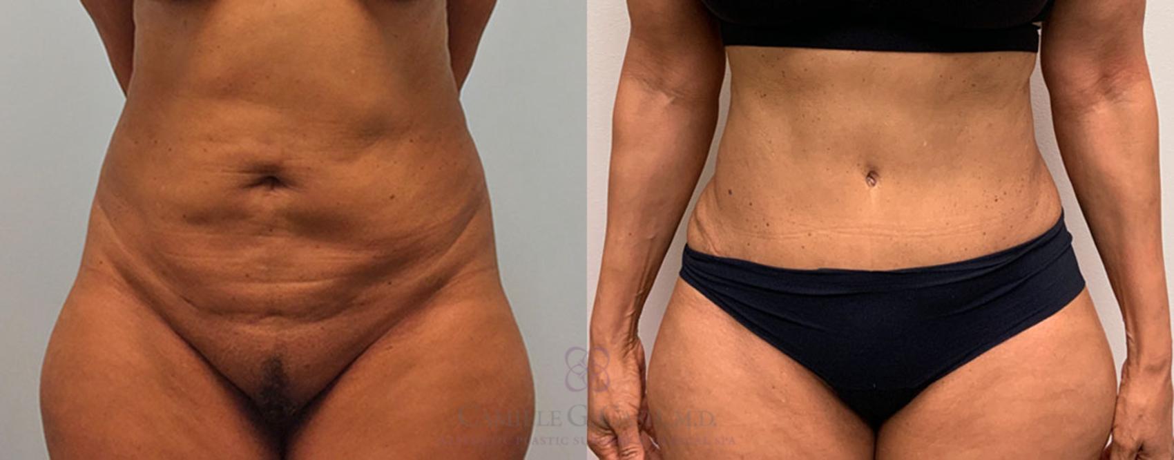 Before & After Tummy Tuck Case 216 View #7 View in Houston, TX
