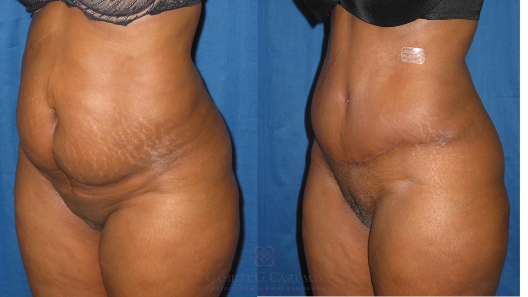 Before & After Tummy Tuck Case 230 Right Oblique View in Houston, TX