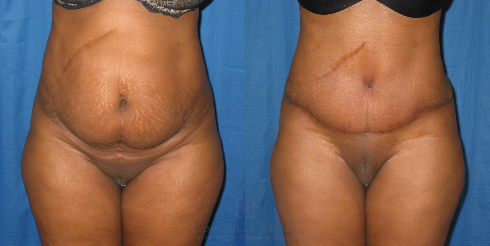 Before & After Tummy Tuck Case 230 View #1 View in Houston, TX