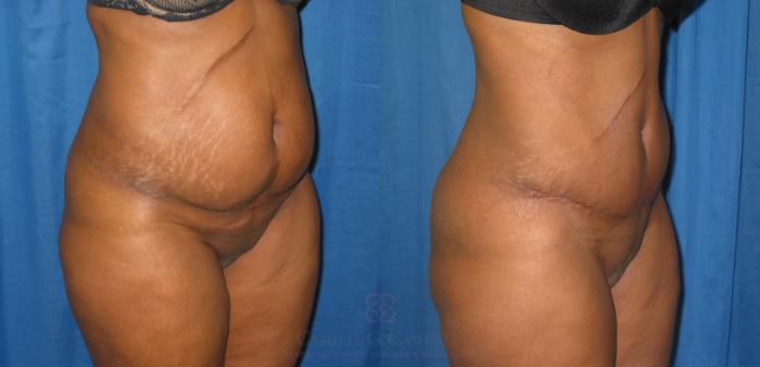 Before & After Tummy Tuck Case 230 View #2 View in Houston, TX