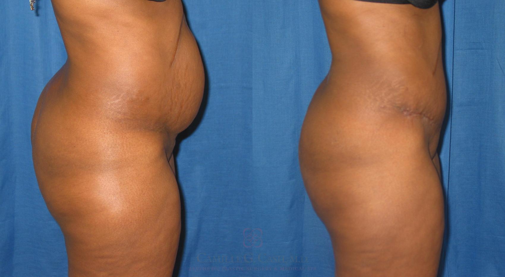 Before & After Tummy Tuck Case 230 View #3 View in Houston, TX