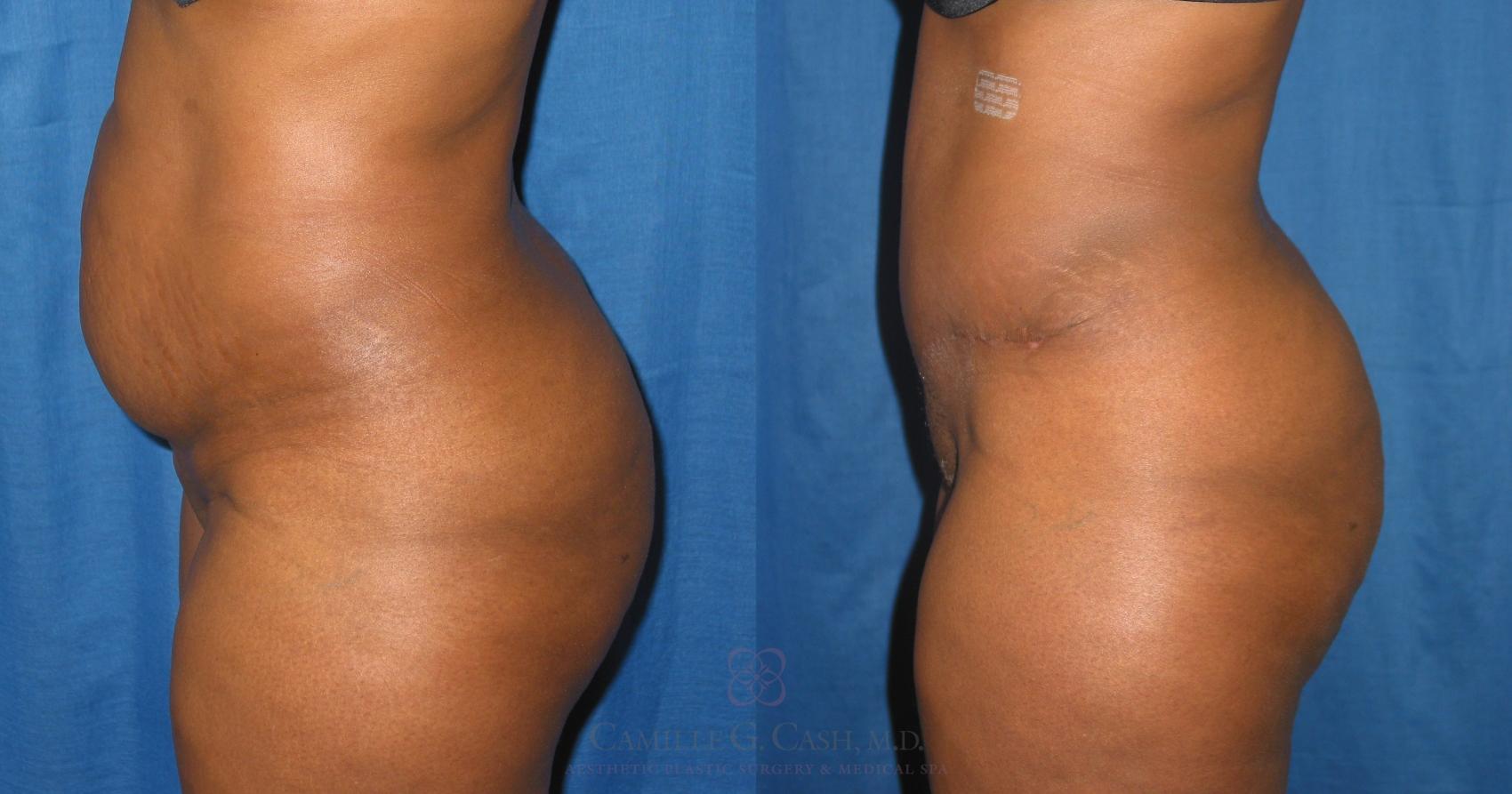 Before & After Tummy Tuck Case 230 View #4 View in Houston, TX