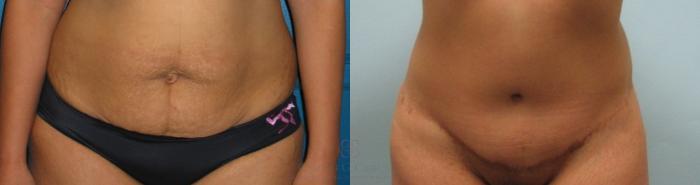 Before & After Tummy Tuck Case 241 View #1 View in Houston, TX