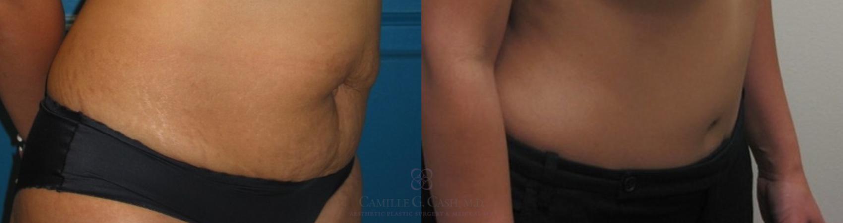 Before & After Tummy Tuck Case 241 View #2 View in Houston, TX