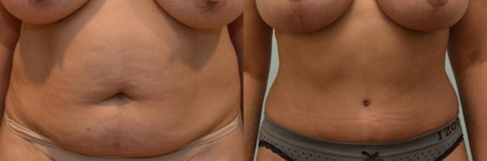 Before & After Tummy Tuck Case 243 View #1 View in Houston, TX