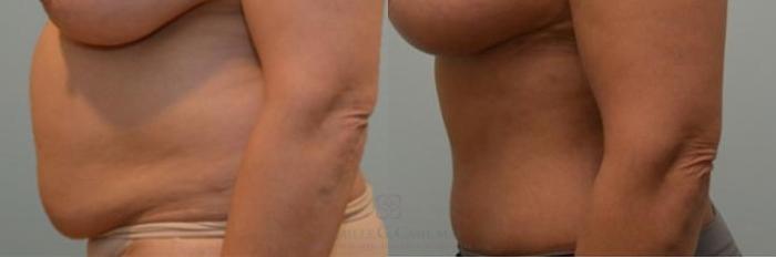 Before & After Tummy Tuck Case 243 View #2 View in Houston, TX