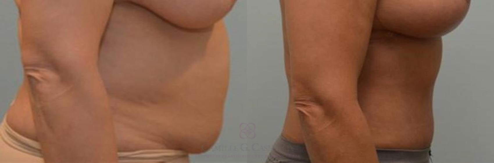 Before & After Tummy Tuck Case 243 View #3 View in Houston, TX