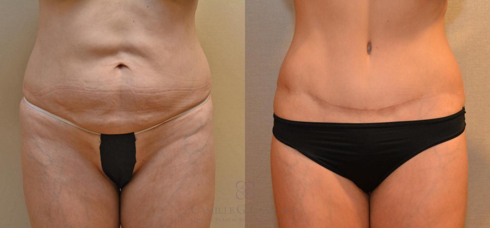 Before & After Tummy Tuck Case 246 View #1 View in Houston, TX
