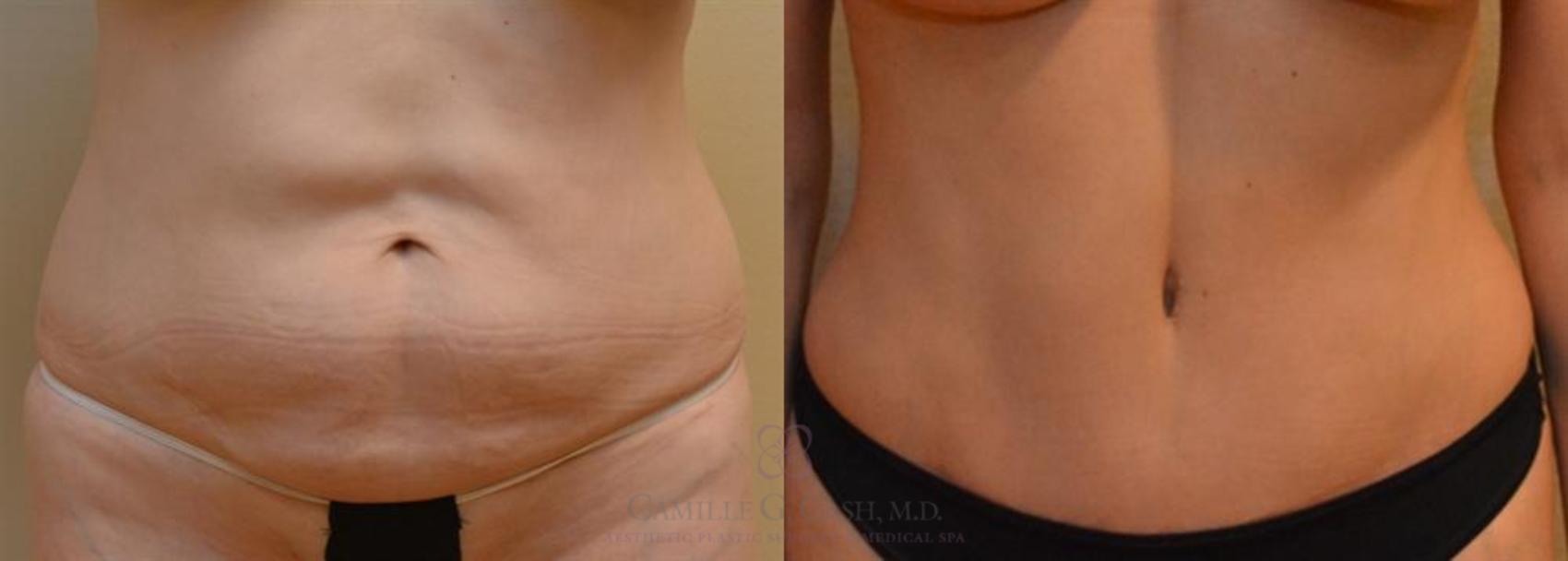 Before & After Tummy Tuck Case 246 View #2 View in Houston, TX