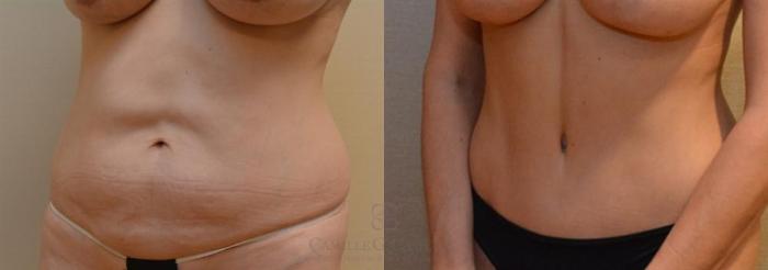 Before & After Tummy Tuck Case 246 View #3 View in Houston, TX