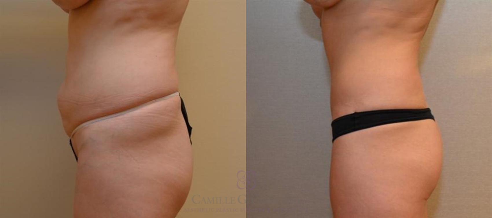 Before & After Tummy Tuck Case 246 View #4 View in Houston, TX