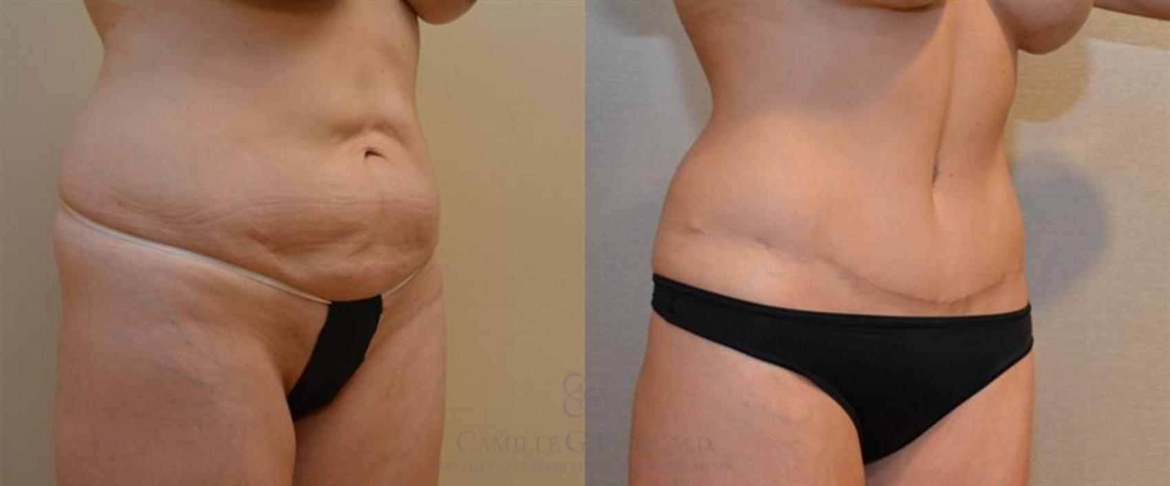 Before & After Tummy Tuck Case 246 View #5 View in Houston, TX