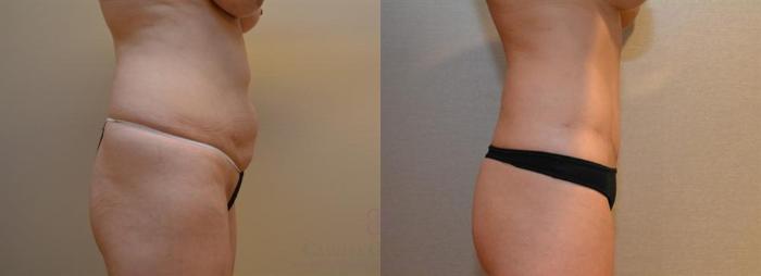 Before & After Tummy Tuck Case 246 View #6 View in Houston, TX