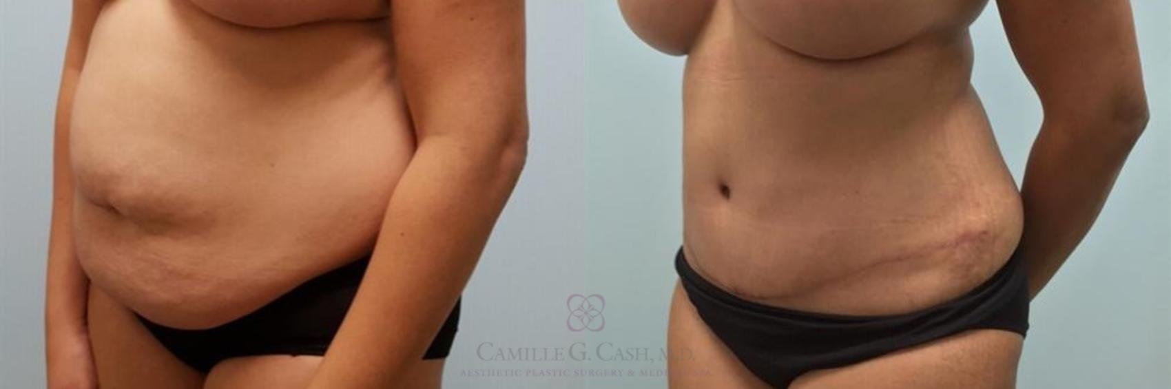 Before & After Tummy Tuck Case 248 View #2 View in Houston, TX