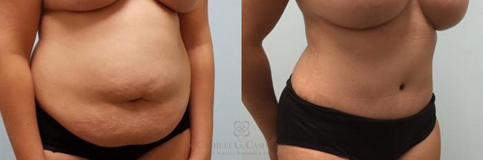 Before & After Tummy Tuck Case 248 View #3 View in Houston, TX