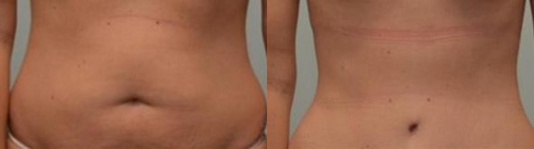 Before & After Tummy Tuck Case 252 View #1 View in Houston, TX