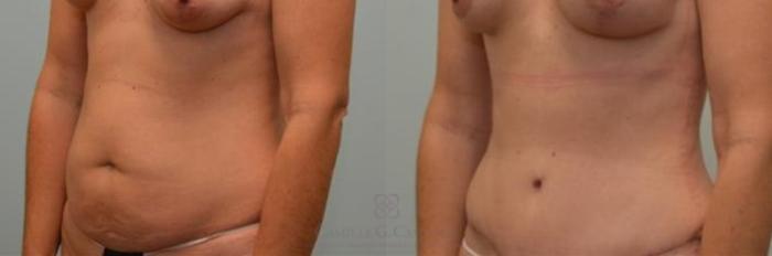 Before & After Tummy Tuck Case 252 View #2 View in Houston, TX