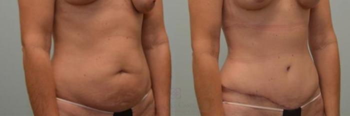 Before & After Tummy Tuck Case 252 View #3 View in Houston, TX