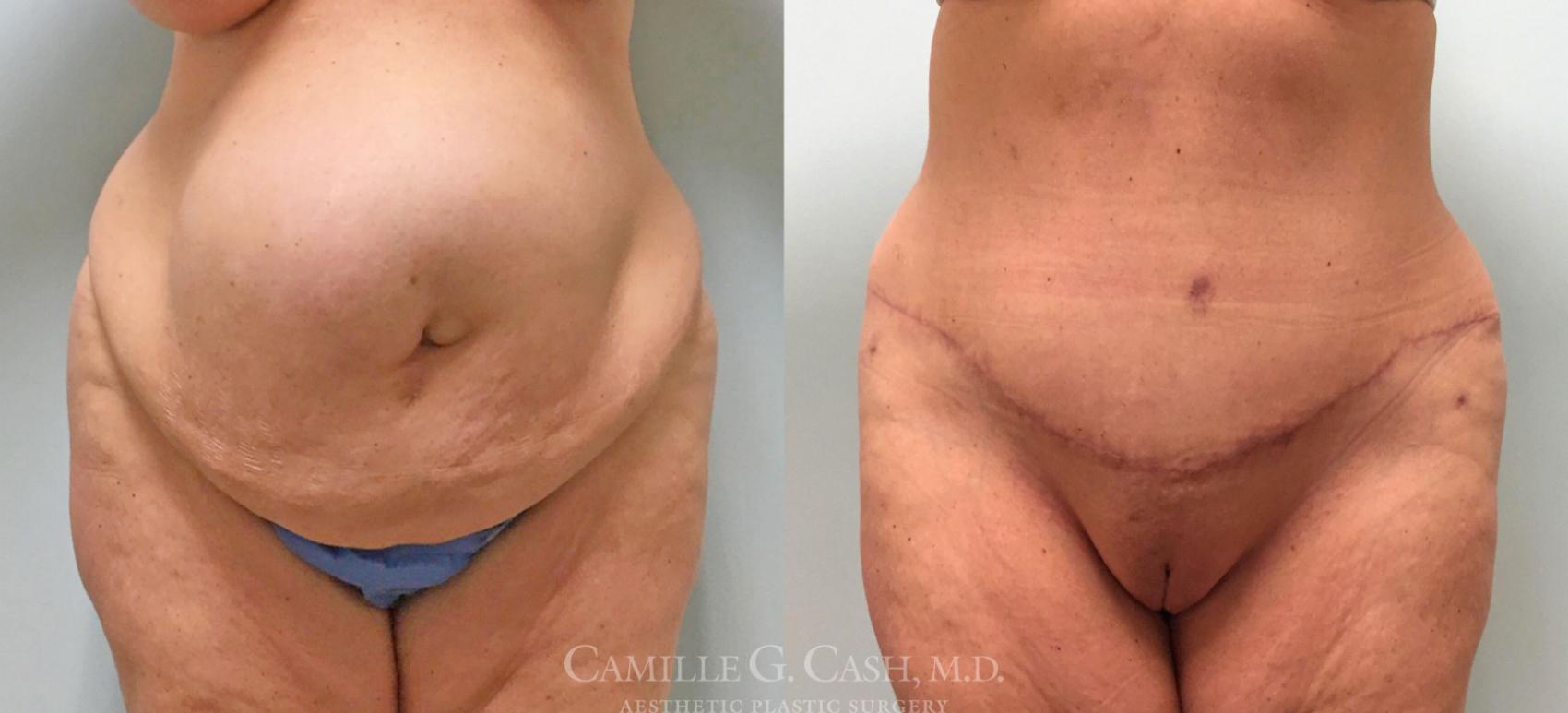 Before & After Tummy Tuck Case 253 View #1 View in Houston, TX