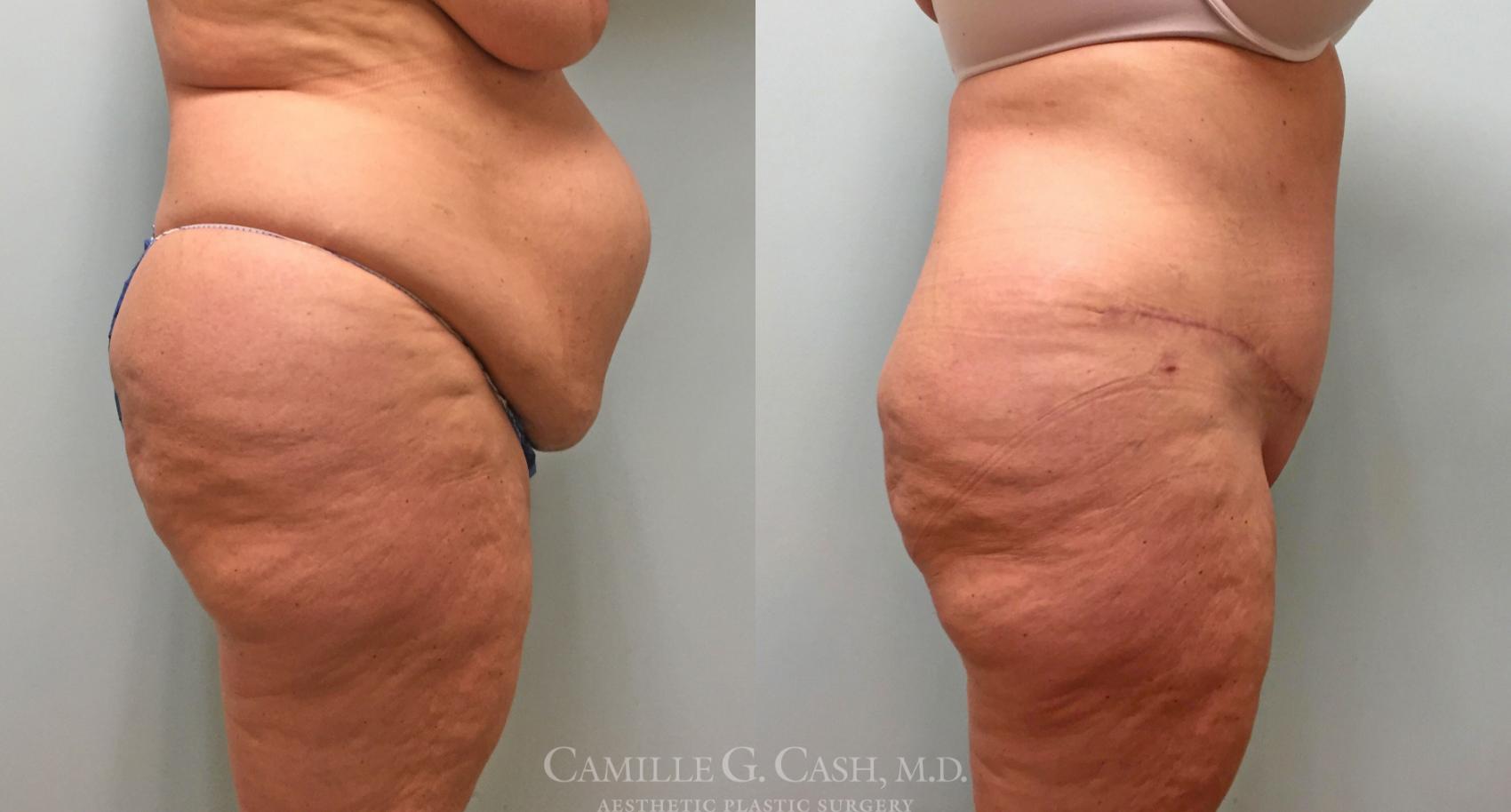 Before & After Tummy Tuck Case 253 View #5 View in Houston, TX