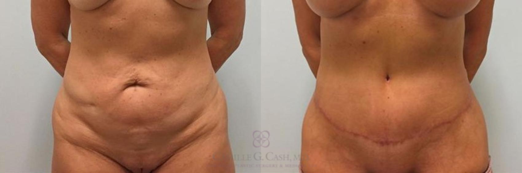 Before & After Tummy Tuck Case 264 View #1 View in Houston, TX