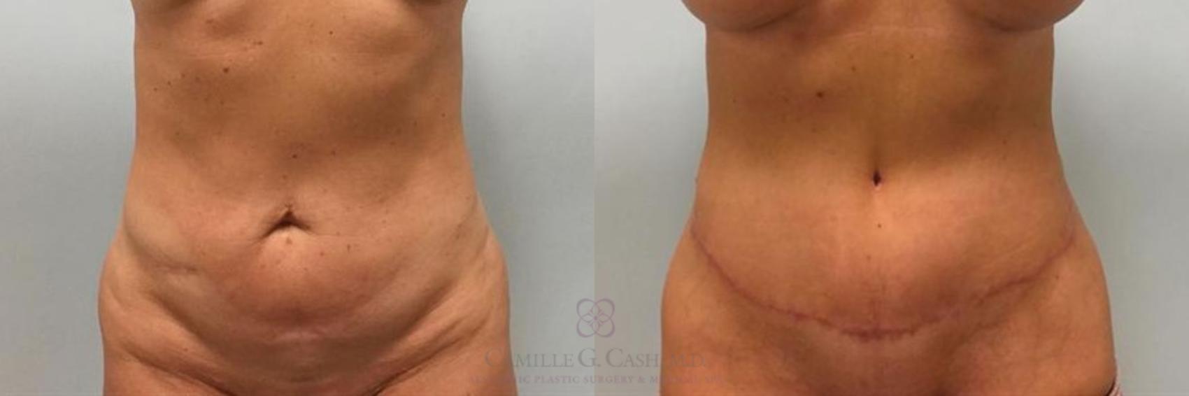 Before & After Tummy Tuck Case 264 View #2 View in Houston, TX