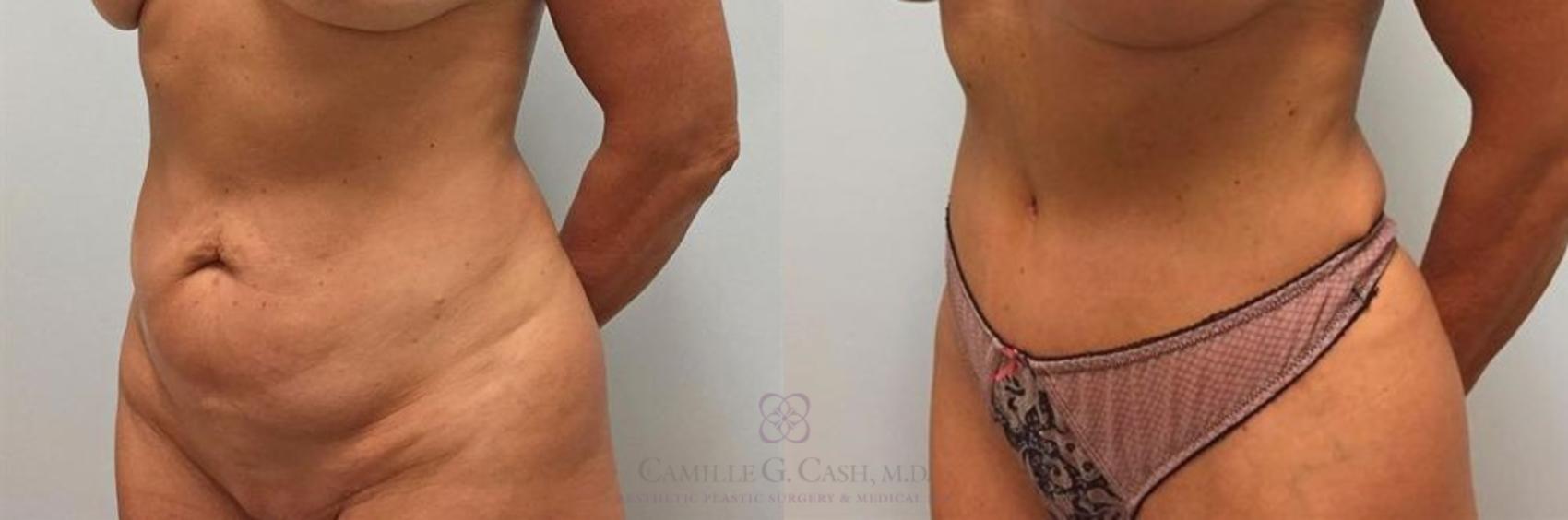 Before & After Tummy Tuck Case 264 View #3 View in Houston, TX