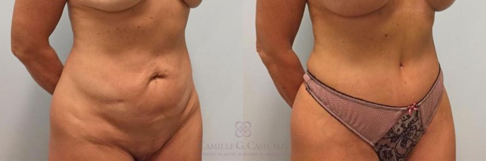 Before & After Tummy Tuck Case 264 View #4 View in Houston, TX