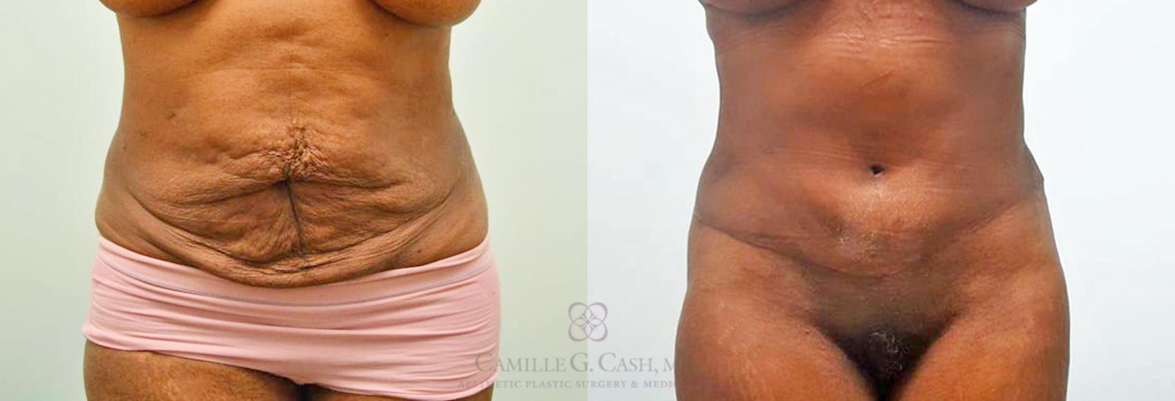 Before & After Tummy Tuck Case 268 View #1 View in Houston, TX