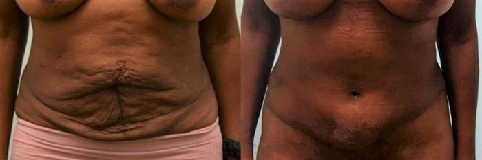 Before & After Tummy Tuck Case 268 View #2 View in Houston, TX
