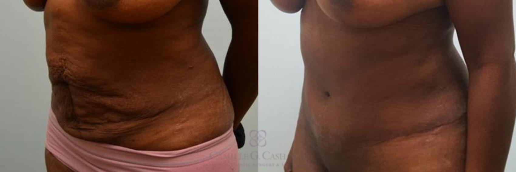 Before & After Tummy Tuck Case 268 View #3 View in Houston, TX