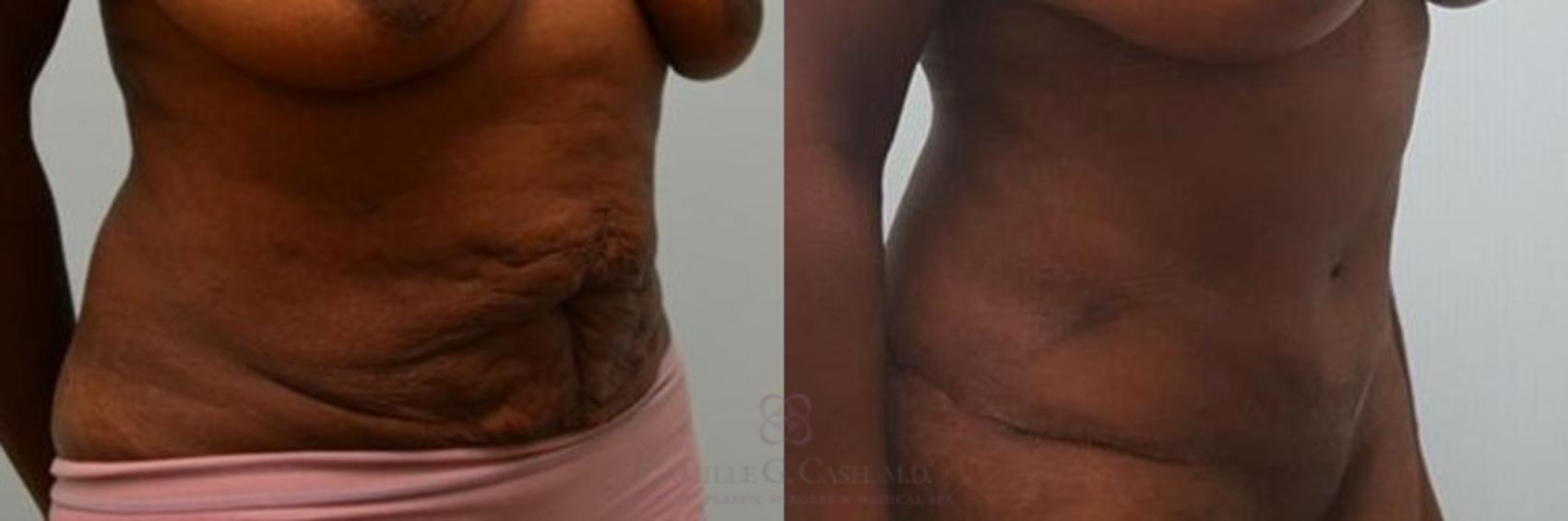 Before & After Tummy Tuck Case 268 View #4 View in Houston, TX