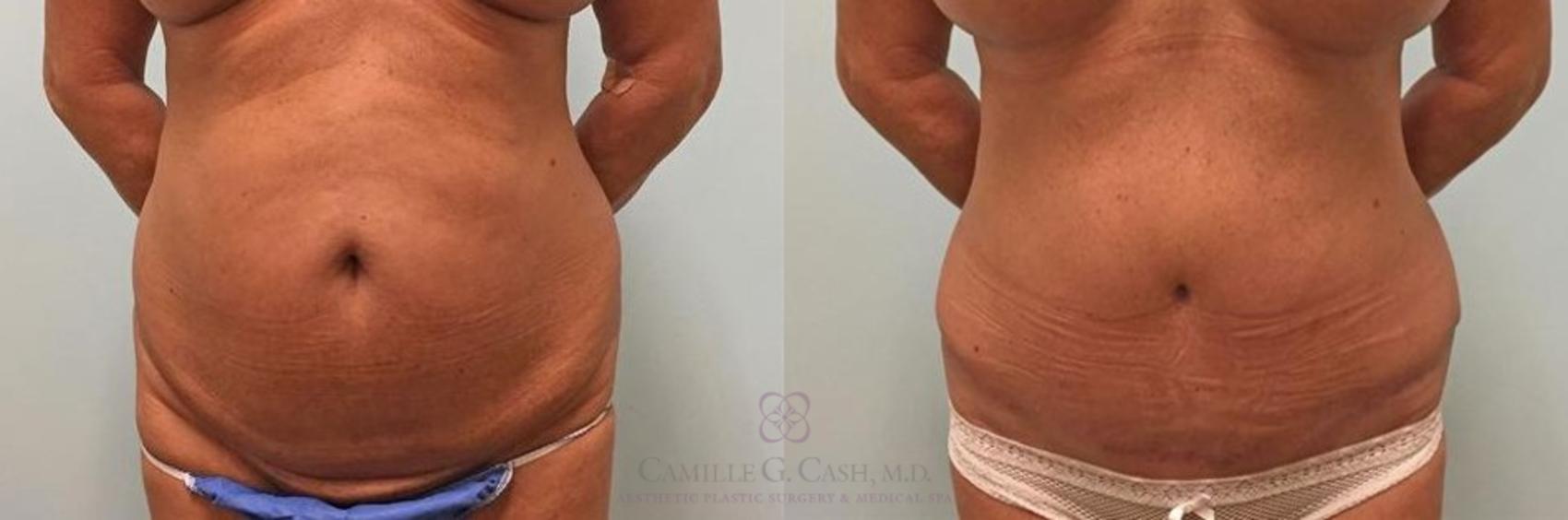 Before & After Tummy Tuck Case 270 View #1 View in Houston, TX