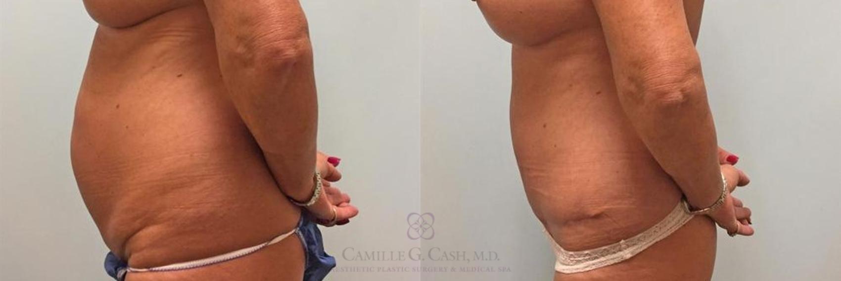 Before & After Tummy Tuck Case 270 View #2 View in Houston, TX