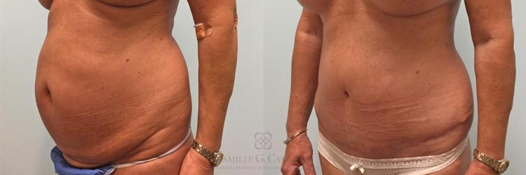 Before & After Tummy Tuck Case 270 View #3 View in Houston, TX