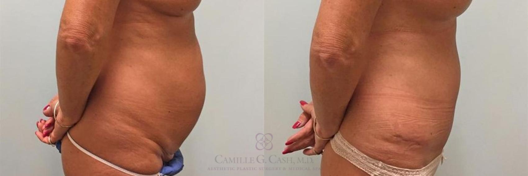 Before & After Tummy Tuck Case 270 View #4 View in Houston, TX