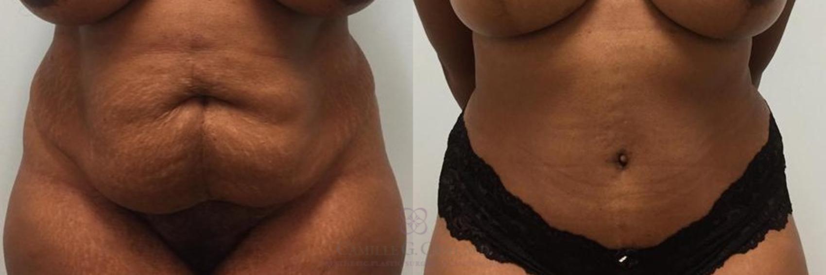 Before & After Tummy Tuck Case 272 View #1 View in Houston, TX