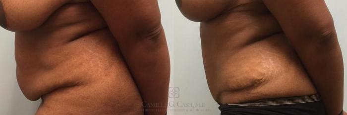 Before & After Tummy Tuck Case 272 View #2 View in Houston, TX