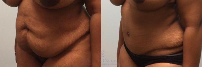 Before & After Tummy Tuck Case 272 View #3 View in Houston, TX
