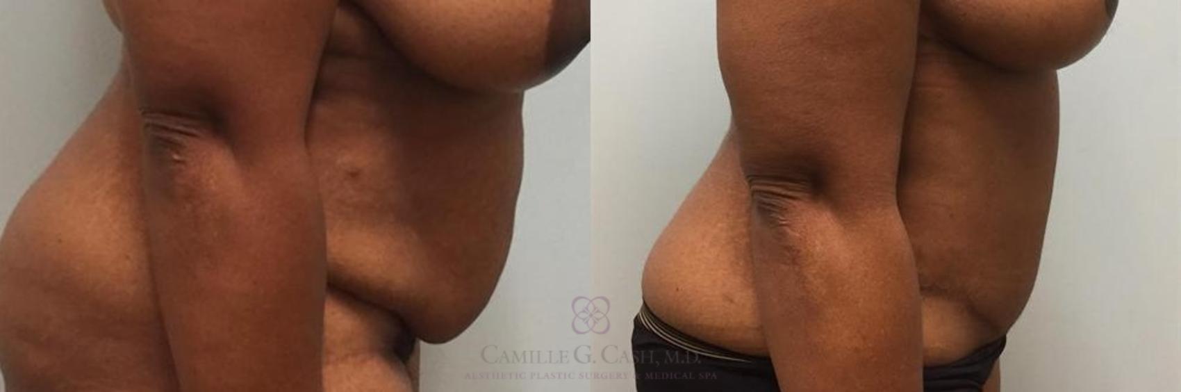 Before & After Tummy Tuck Case 272 View #4 View in Houston, TX