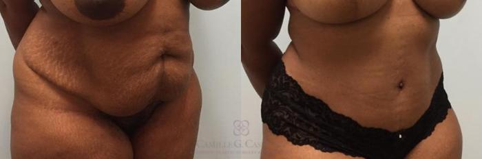 Before & After Tummy Tuck Case 272 View #5 View in Houston, TX