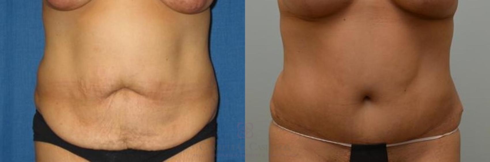 Before & After Tummy Tuck Case 273 View #1 View in Houston, TX
