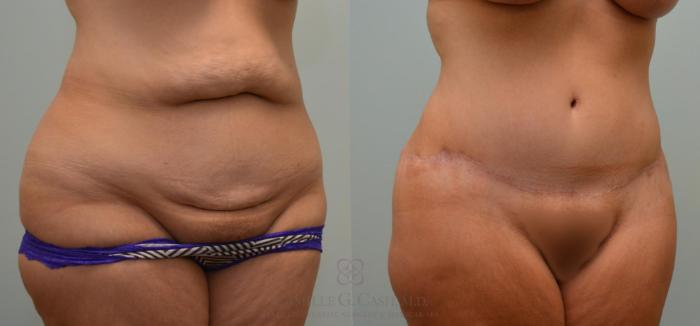 Before & After Tummy Tuck Case 276 View #2 View in Houston, TX