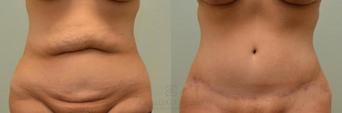 Before & After Tummy Tuck Case 276 View #3 View in Houston, TX
