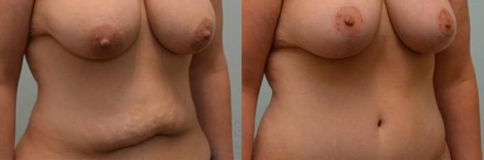 Before & After Tummy Tuck Case 276 View #5 View in Houston, TX