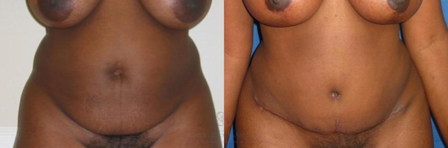 Before & After Tummy Tuck Case 281 View #1 View in Houston, TX