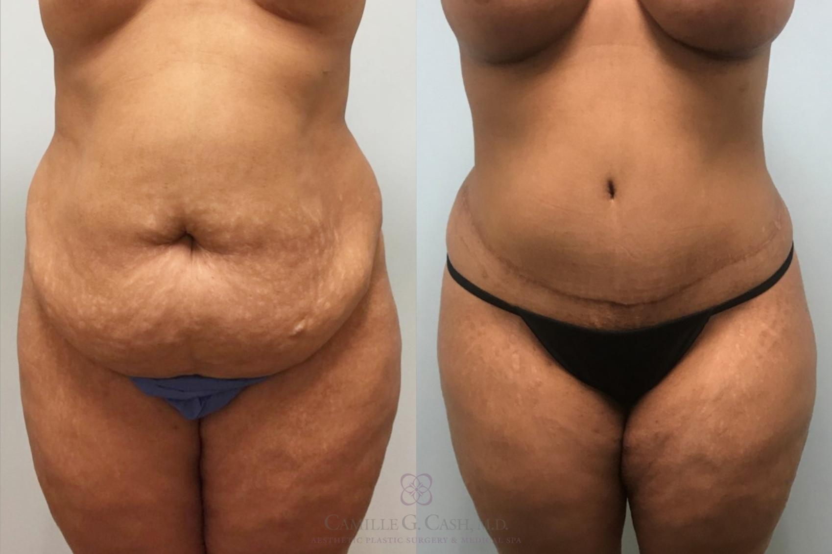 Before & After Tummy Tuck Case 308 Front View in Houston, TX