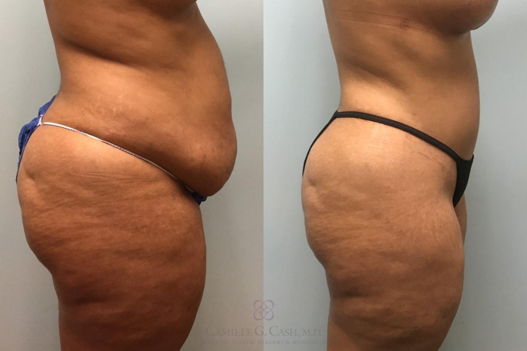 Before & After Tummy Tuck Case 308 Left Side View in Houston, TX
