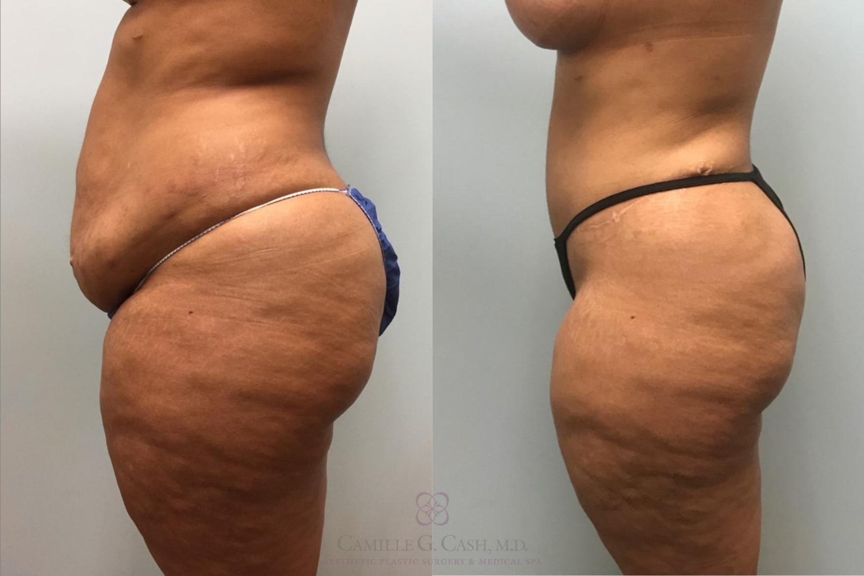 Before & After Tummy Tuck Case 308 Right Side View in Houston, TX