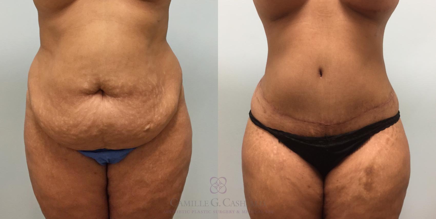 Before & After Tummy Tuck Case 308 View #5 View in Houston, TX